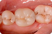Nach der Amalgamentfernung und Behandlung von Zahnkaries ist das Implantat zementiert worden