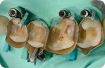 Abgenommene alte Zahnfüllungen und die Vorbereitungsphase für die Zahnrekonstruktion.