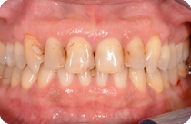 Unschönheiten auf Grund alter und infiltrierter Zahnfüllungen.