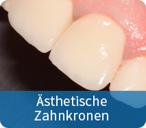Ästhetische Zahnkronen