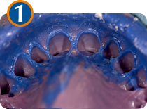 Empreinte des dents