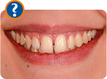 diastema