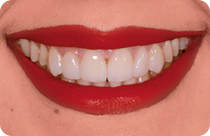 Alessias Lächeln im Detail, vor und nach der Anwendung von Veneers.