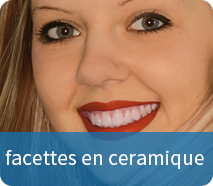 facettes en ceramique