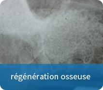 regeneration osseuse