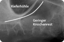 Geringer Knochenrest