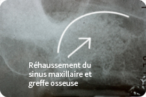 réhaussement du sinus maxillaire