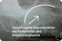 Geschlossene Sinuselevation der Kieferhöhle und Knochenimplantat