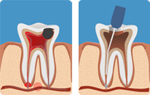 Dent infectée à dévitaliser