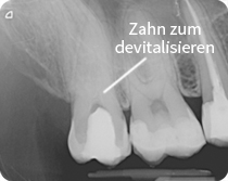 zahn zum devitalisieren