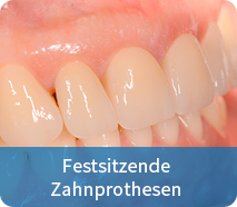 festsitzende zahnprothesen