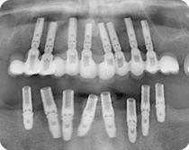 Im Oberkiefer ein kreisförmiges Implantat