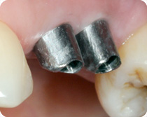 Einsetzen der Stifte in die Implantate.